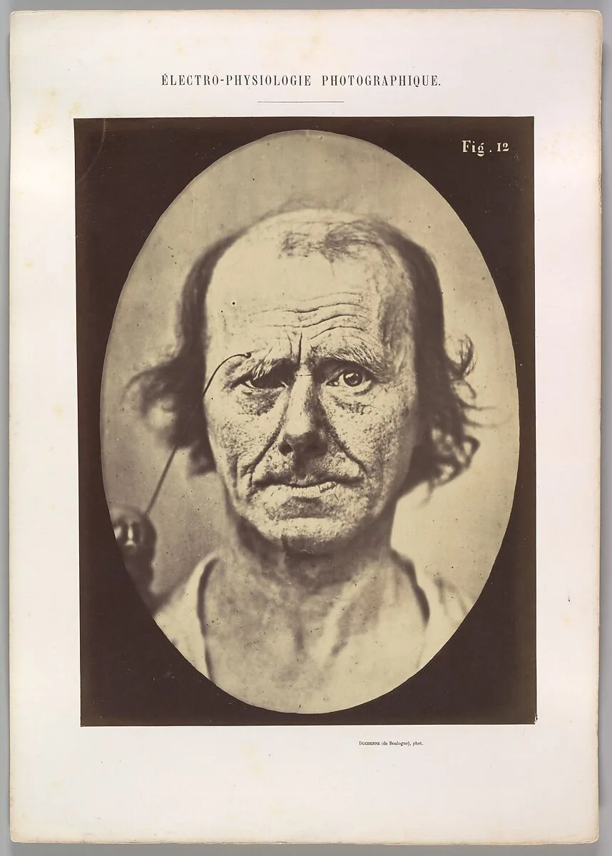 Figure 12: A study of the contraction of and the expression produced by the superior part of m. orbicularis oculi — Guillaume-Benjamin-Amand Duchenne de Boulogne|Adrien Tournachon