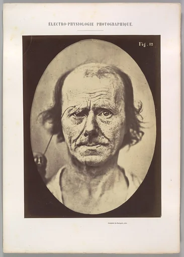 Figure 12: A study of the contraction of and the expression produced by the superior part of m. orbicularis oculi