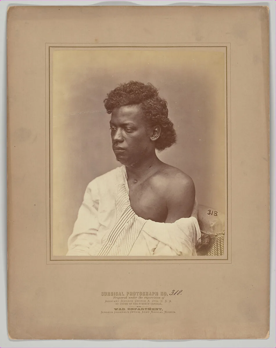 Fistulous Openings in the Jaw and Neck — William Bell