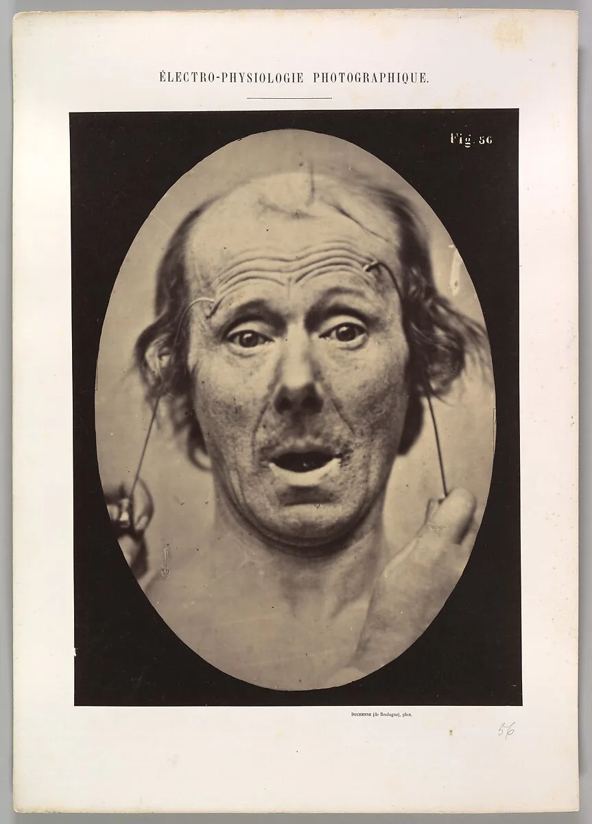 Figure 56: Surprise — Guillaume-Benjamin-Amand Duchenne de Boulogne|Adrien Tournachon