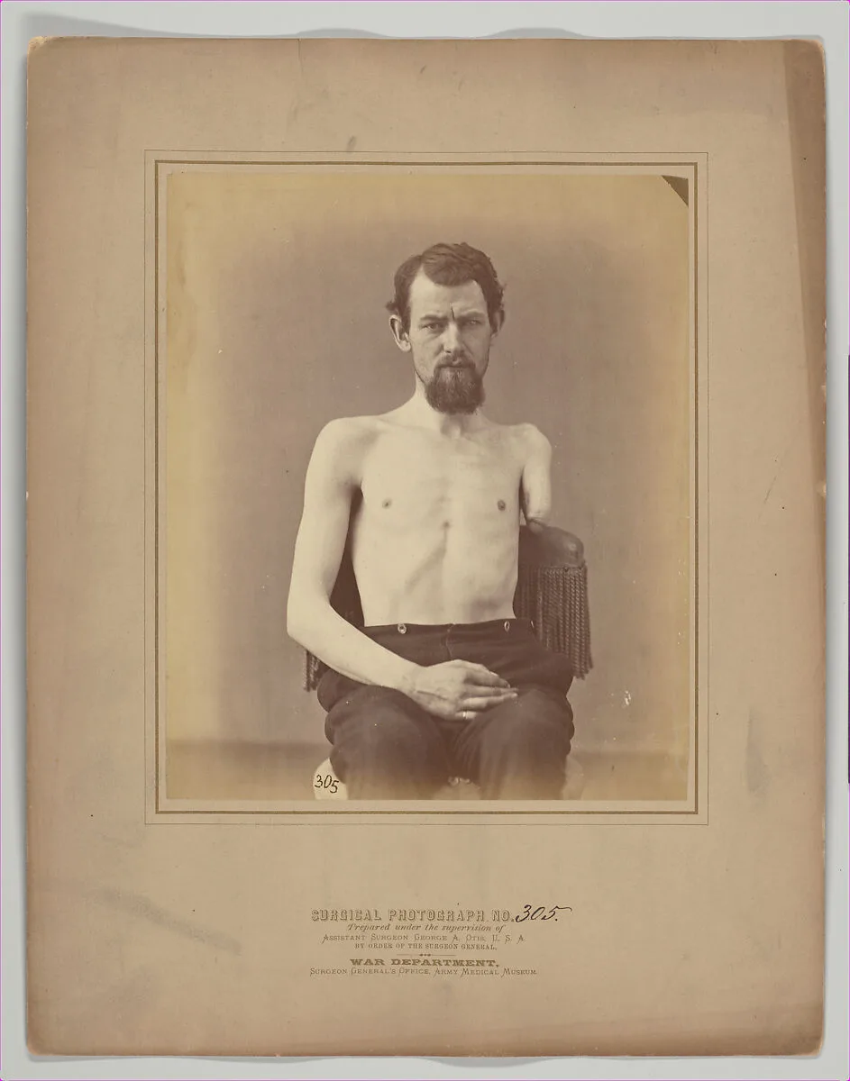 Amputation of the Left Arm for Gunshot Injury — E. J. Ward