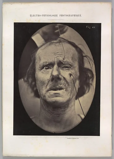 Figure 49: Painful weeping and forward looking.