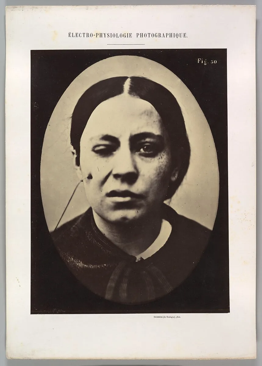 Figure 50: Affected weeping and face in repose — Guillaume-Benjamin-Amand Duchenne de Boulogne|Adrien Tournachon
