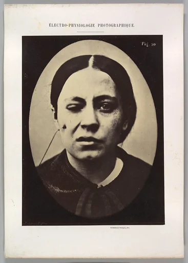 Figure 50: Affected weeping and face in repose