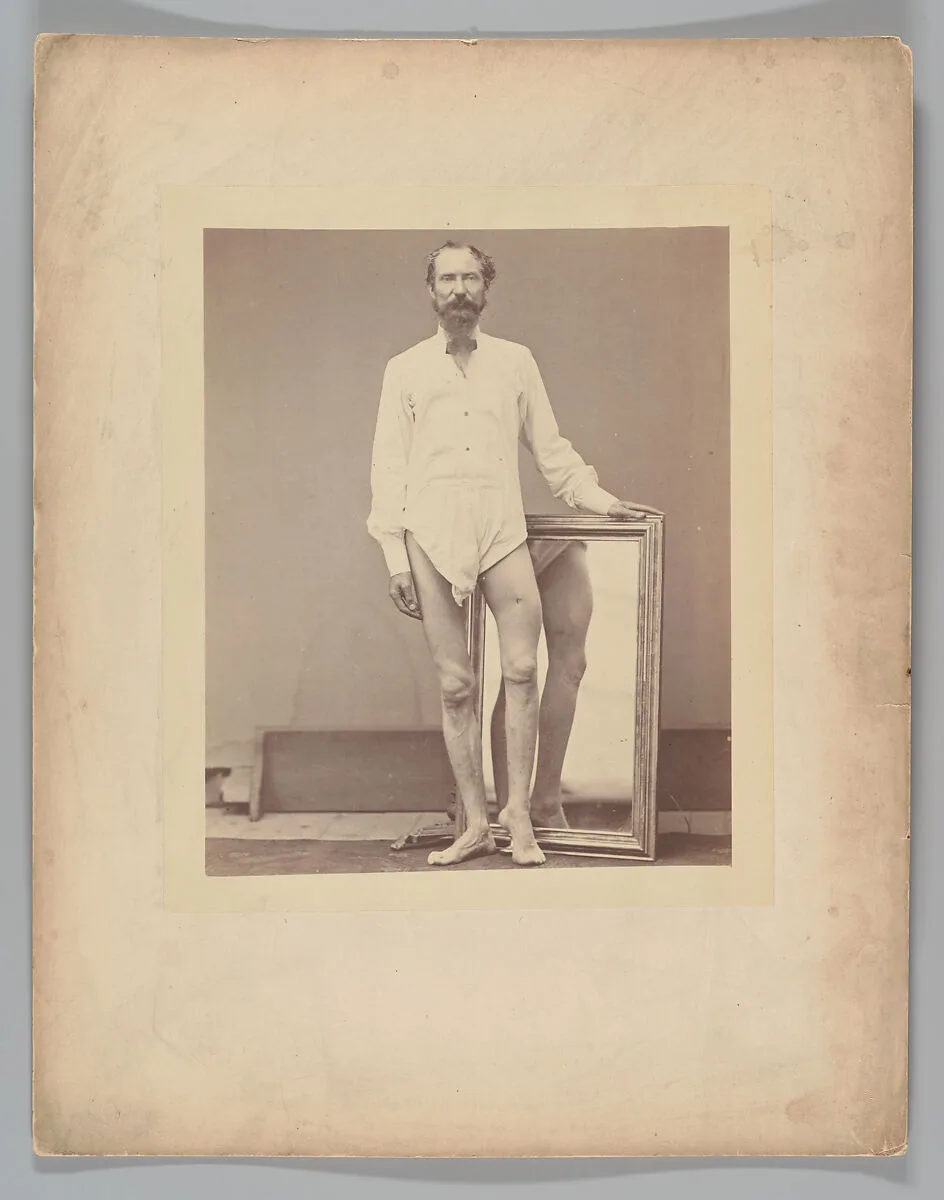 Gunshot Wound of Middle Third of Left Femur — William Bell