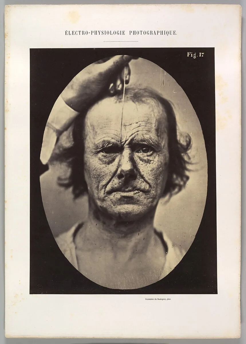Figure 17: On the right, electrization of m. procerus: severity, aggression. On the left: attention. — Guillaume-Benjamin-Amand Duchenne de Boulogne|Adrien Tournachon