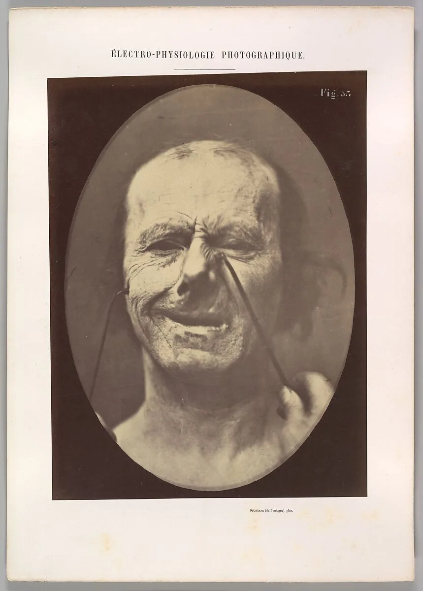 Figure 53: Whimpering and false laughter — Guillaume-Benjamin-Amand Duchenne de Boulogne|Adrien Tournachon