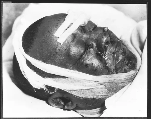 [Copy of Newspaper File Photograph: Bandaged Head, Probably Havana]