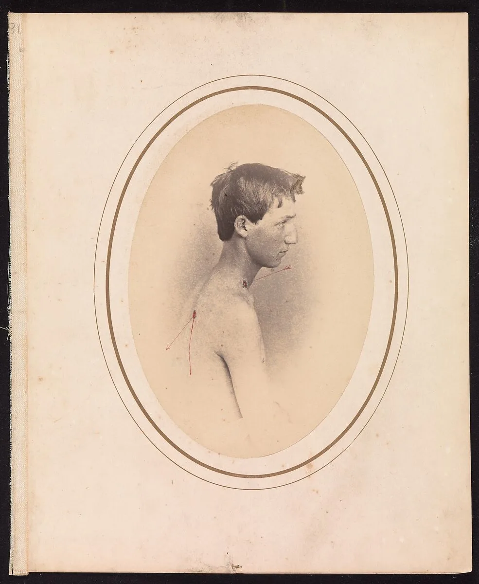 Private Jacob F. Simmons, Company H, Eighty-second Pennsylvania Volunteers — Reed Brockway Bontecou