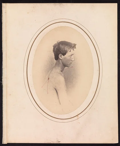 Private Jacob F. Simmons, Company H, Eighty-second Pennsylvania Volunteers