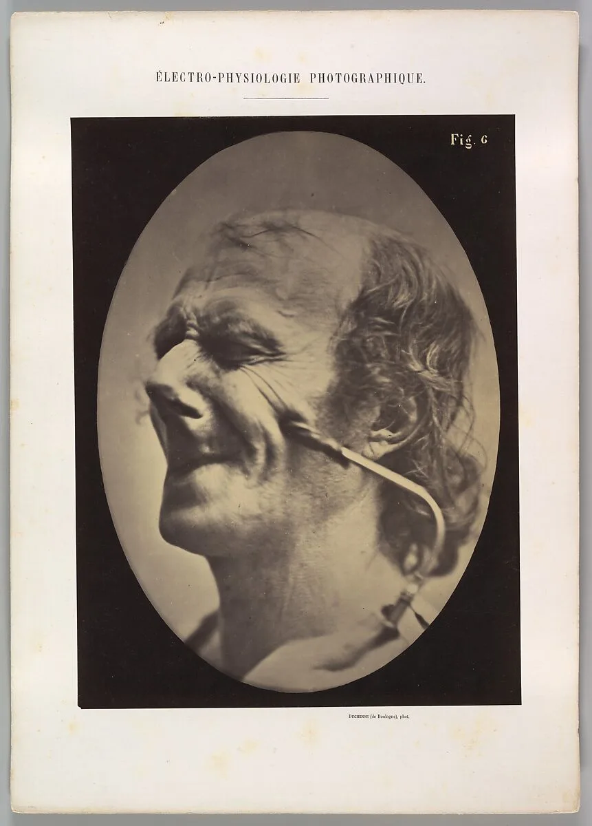 Figure 6: The grimice produced is similar to a tic of the face — Guillaume-Benjamin-Amand Duchenne de Boulogne|Adrien Tournachon
