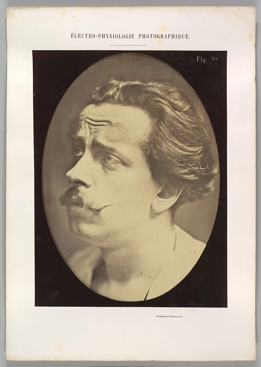 Figure 25: Not an expression of pain — Guillaume-Benjamin-Amand Duchenne de Boulogne|Adrien Tournachon