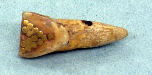 Inlaid Tooth