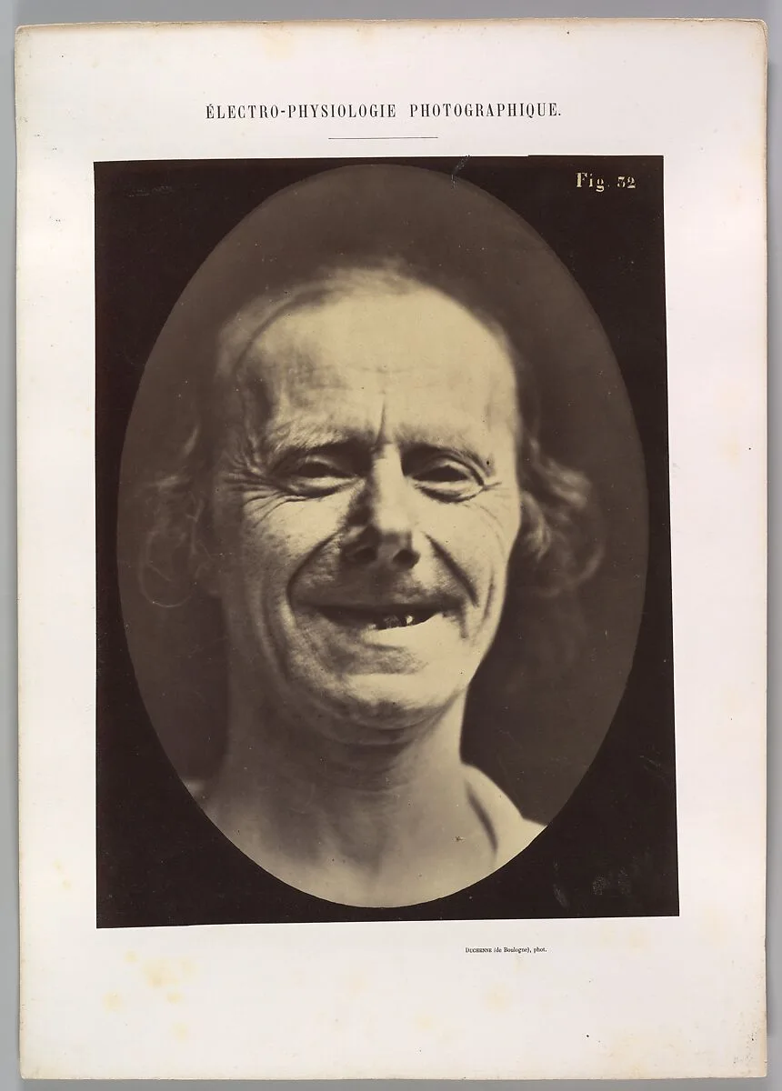 Figure 52: Voluntary retraction of the lower lip — Guillaume-Benjamin-Amand Duchenne de Boulogne|Adrien Tournachon