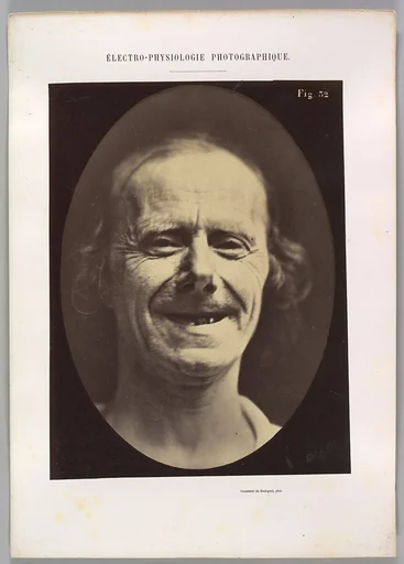 Figure 52: Voluntary retraction of the lower lip