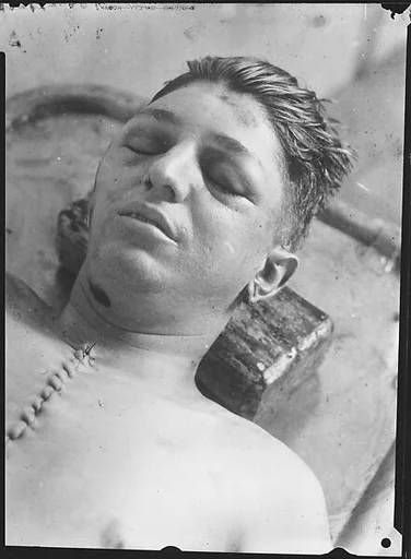 [Copy of Newspaper File Photograph: Corpse with Sutured Chest, Probably Havana]