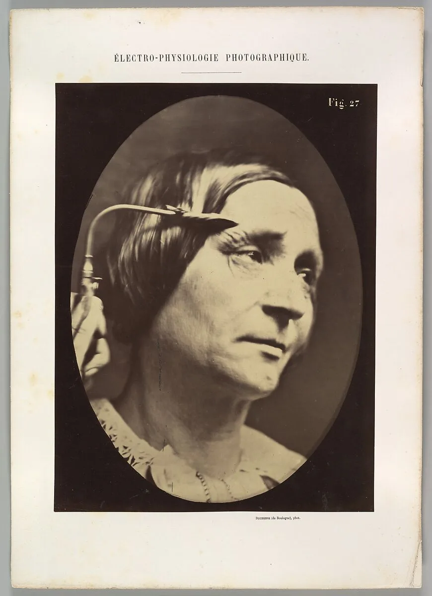 Figure 27: Expression proportionally more pained — Guillaume-Benjamin-Amand Duchenne de Boulogne|Adrien Tournachon