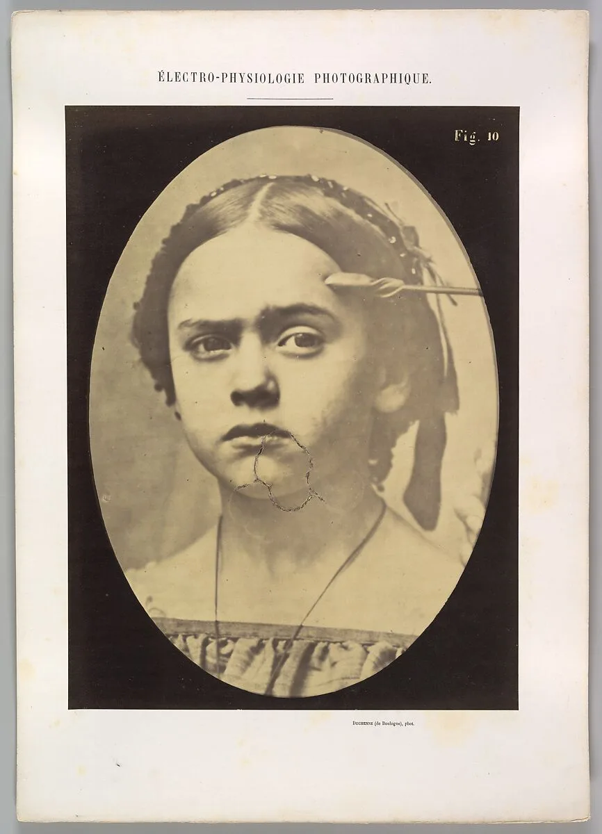 Figure 10: Showing the expressive lines of m. frontalis in a young girl — Guillaume-Benjamin-Amand Duchenne de Boulogne|Adrien Tournachon