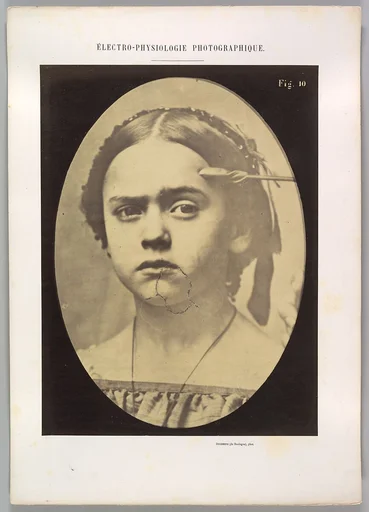 Figure 10: Showing the expressive lines of m. frontalis in a young girl