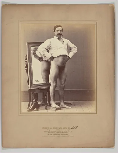 A Compound Comminuted Fracture of the Femur Successfully Treated with Smith's Anterior Splint