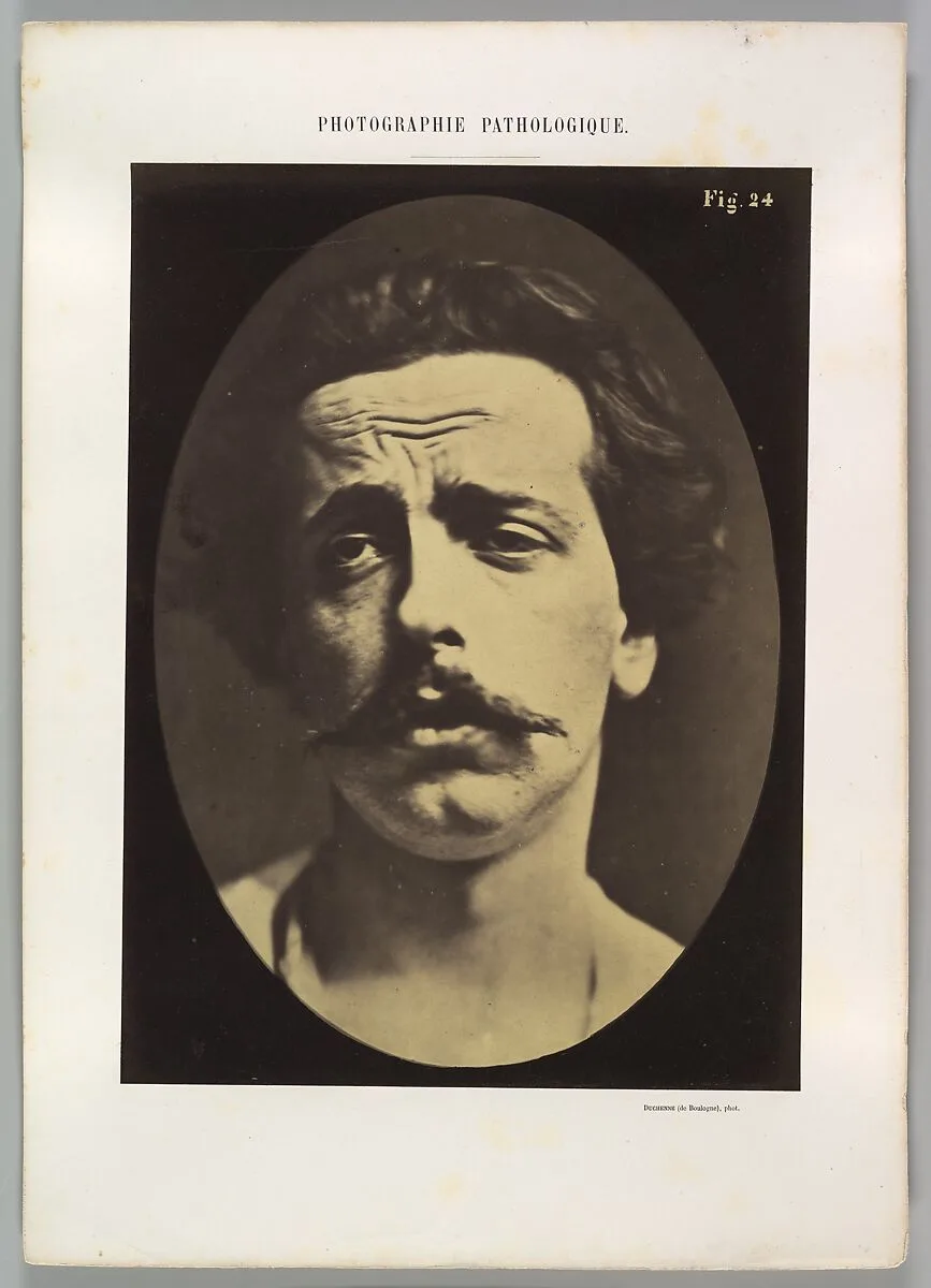 Figure 24: Extreme pain to the point of exhaustion, the head of Christ and memory of love or ecstatic gaze. — Guillaume-Benjamin-Amand Duchenne de Boulogne|Adrien Tournachon