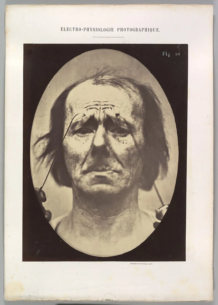 Figure 20: Profound suffering, with resignation — Guillaume-Benjamin-Amand Duchenne de Boulogne|Adrien Tournachon