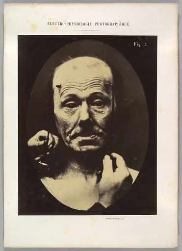 Figure 8: Contraction of the right m. frontalis.
