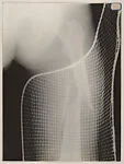 [X-Ray, Broken Right Femur]