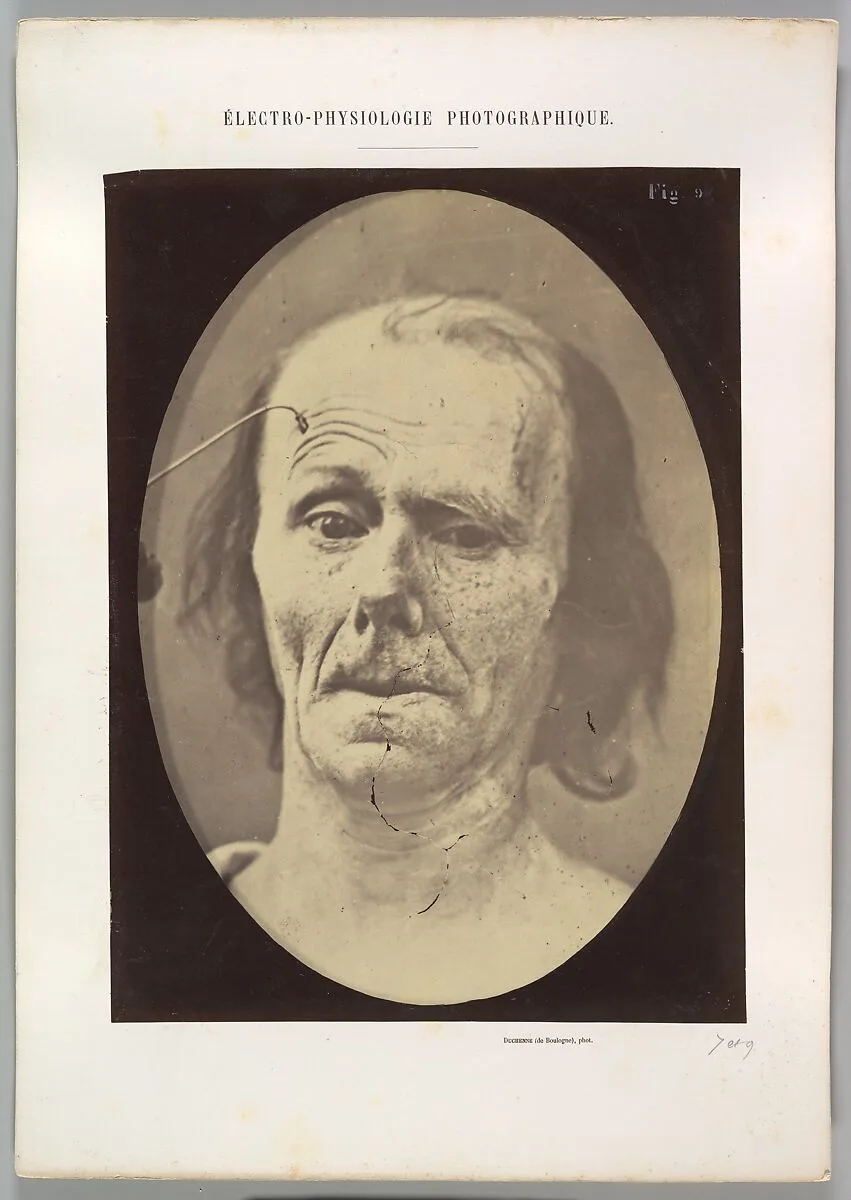 Figure 9: A study of m. frontalis in maximum contraction — Guillaume-Benjamin-Amand Duchenne de Boulogne|Adrien Tournachon