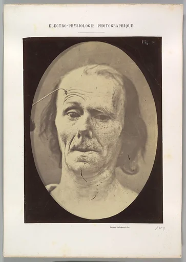 Figure 9: A study of m. frontalis in maximum contraction