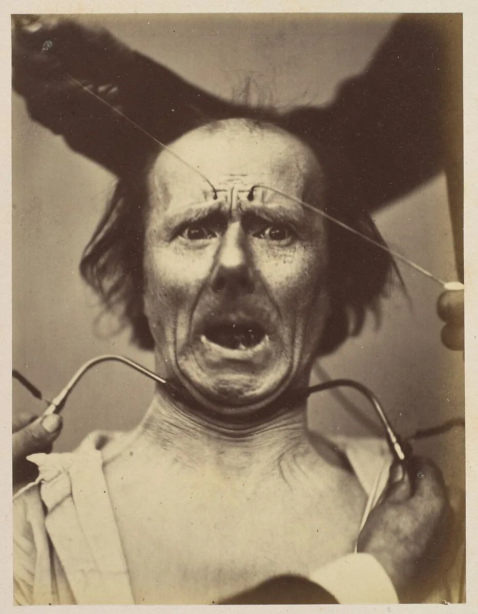 Icono-photographique. Mécanisme de la Physionomie Humaine. Fig. 65 — Guillaume-Benjamin-Amand Duchenne de Boulogne|Adrien Tournachon